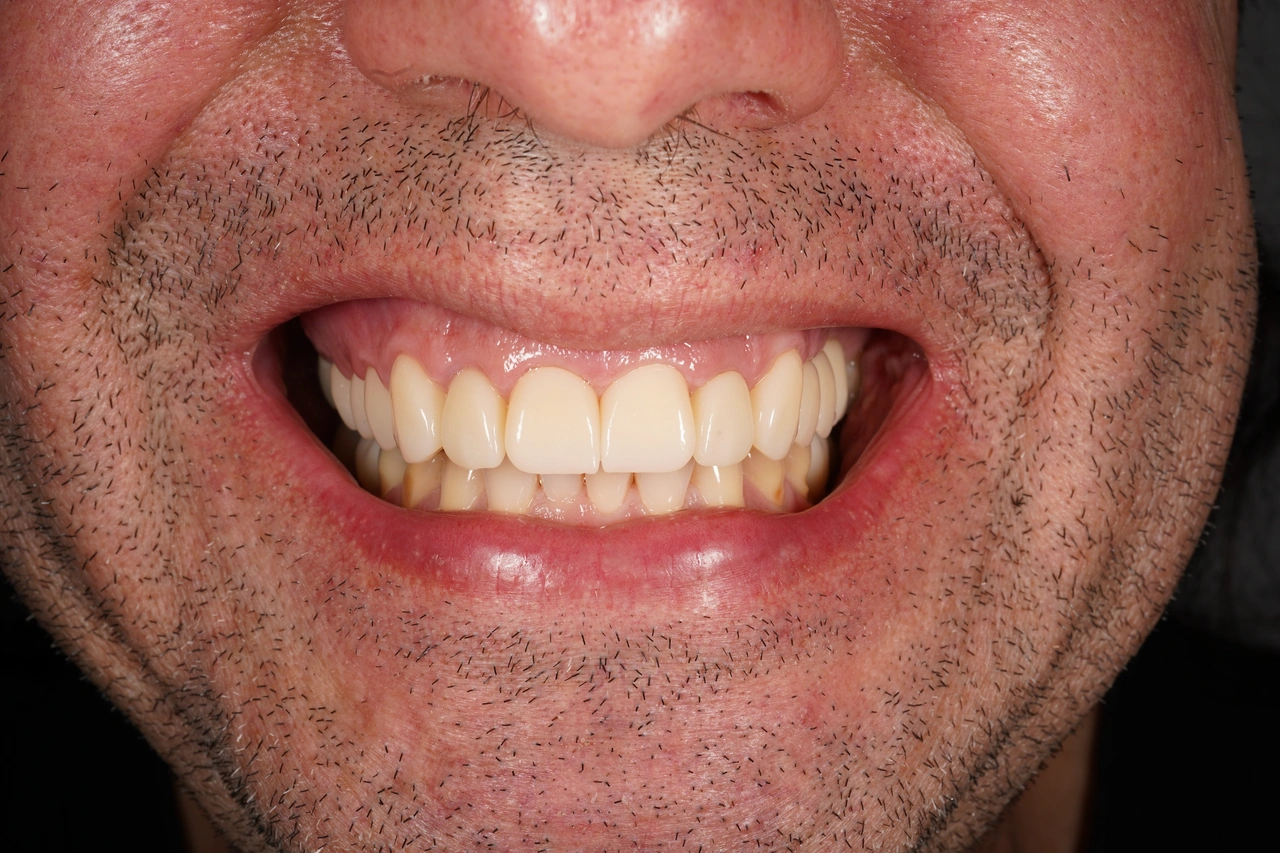 Dentadura en primer plano después del tratamiento