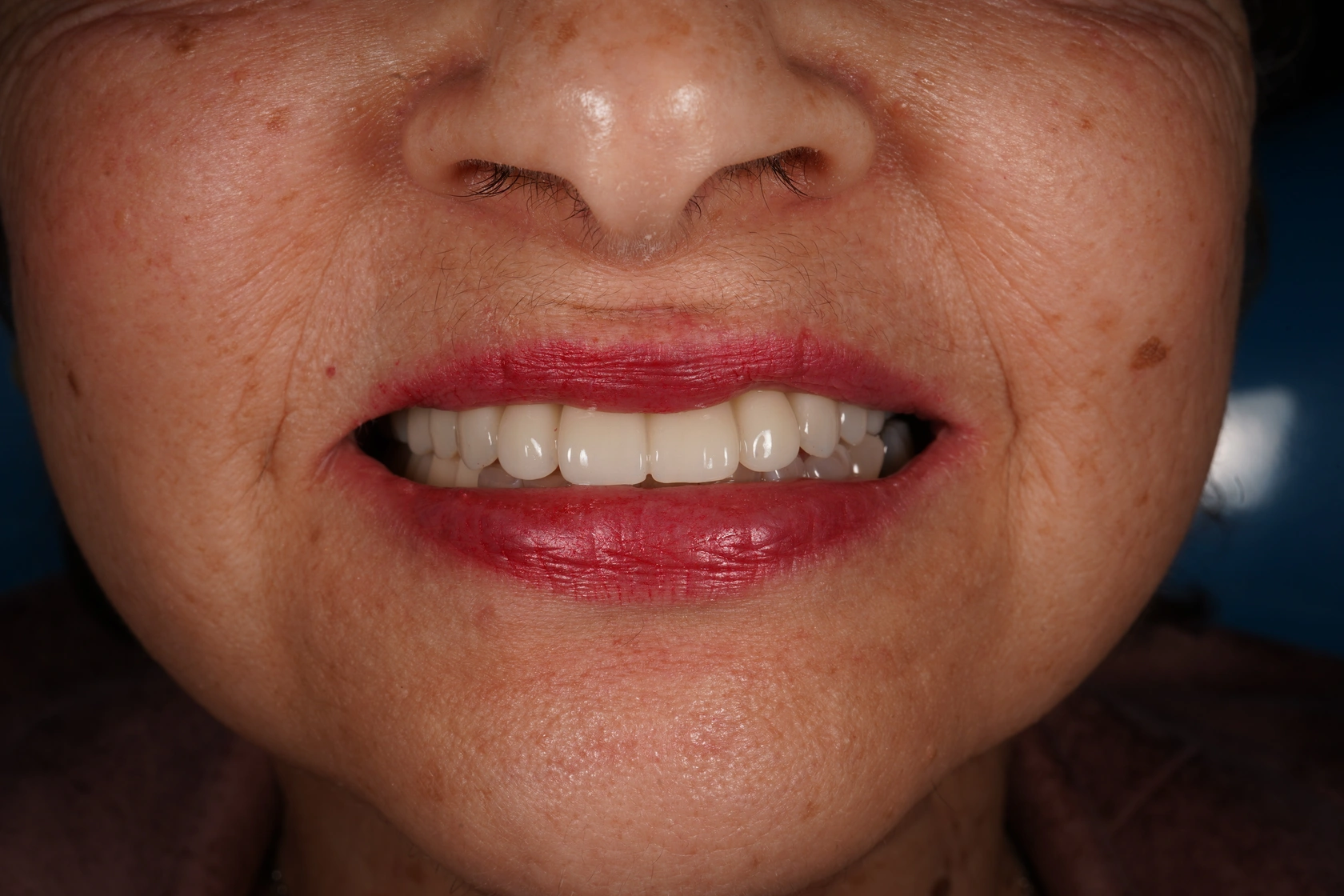 Acercamiento complementario de la sonrisa después del tratamiento