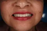 Acercamiento complementario de la sonrisa después del tratamiento