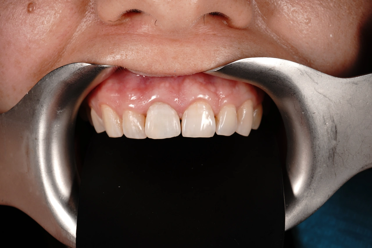 Sonrisa después del blanqueamiento dental