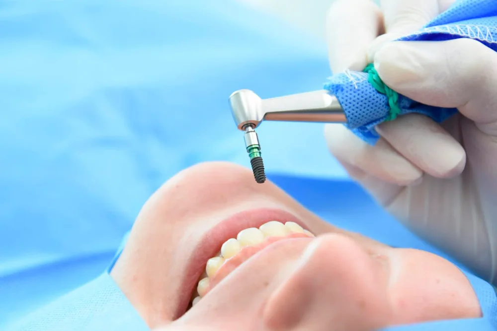 Modelo demostrativo de implante dental
