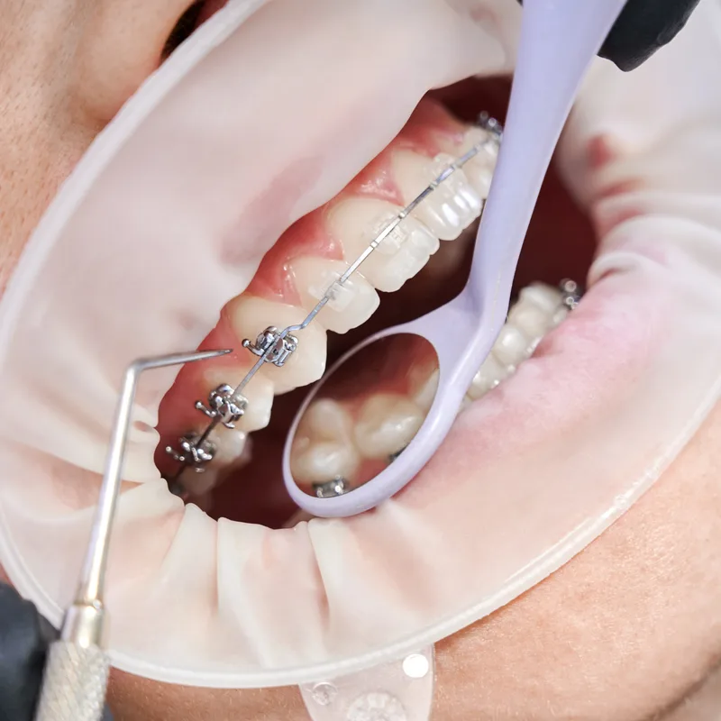 Tratamiento de ortodoncia con brackets