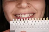 Guía de tonos dentales junto a la sonrisa para comparar colores